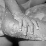 Monkeypox Virus Case Confirmed In UK Know What Is Monkeypox All You Need To Know