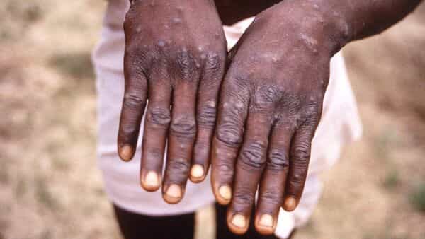 Monkeypox |  Scientists say virus feared to have more mutations than expected