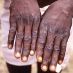 Monkeypox outbreak: How to protect yourself from virus and what to do if you have symptoms