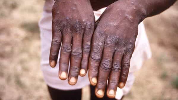 Monkeypox outbreak: How to protect yourself from virus and what to do if you have symptoms